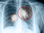 70% bệnh nhân ung thư phổi phát hiện khi đã muộn